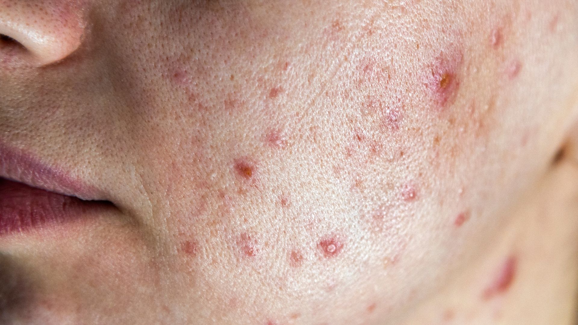 Rekomendasi Sunscreen buat Bapak Sesuai Permasalahan Kulit yang Dipunya